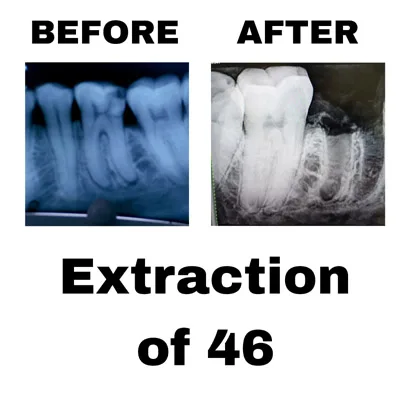 Extraction of 46