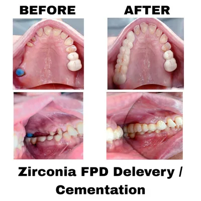 Zirconia FPD Delevary Cementation
